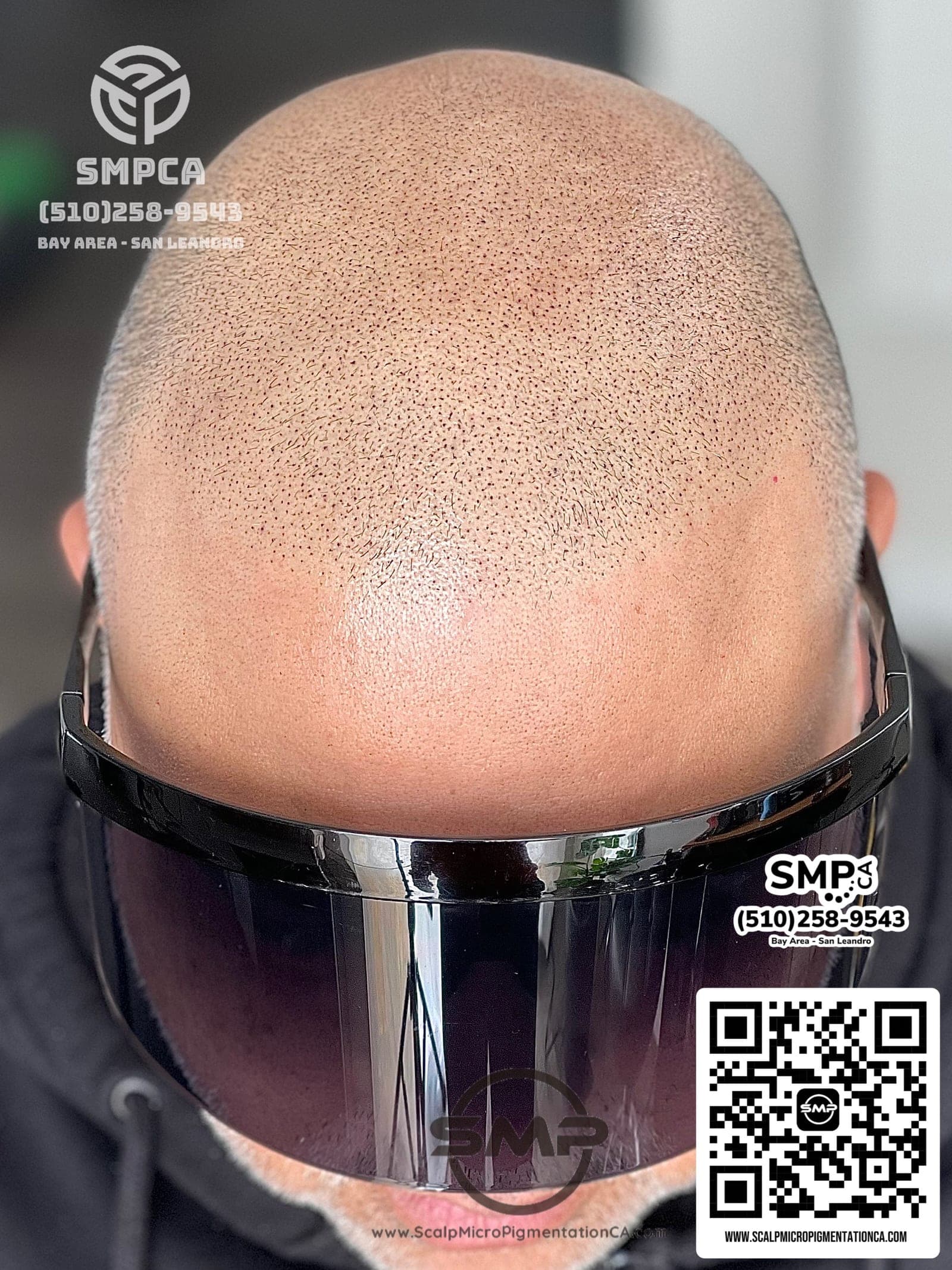 Scalp micropigmentation result for a San Ramon client by SMPCA