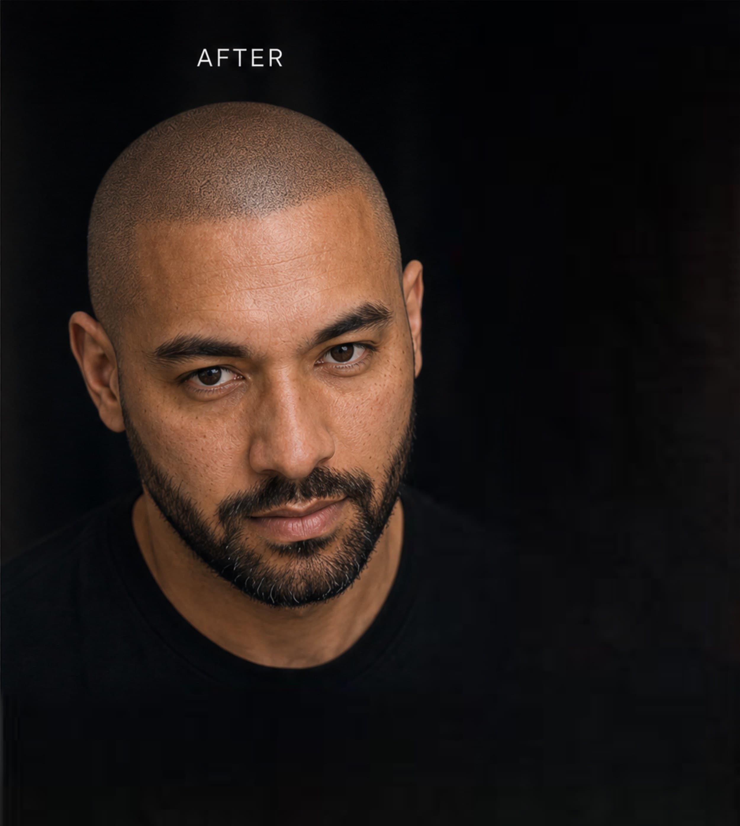 FUT / FUE Scar Camouflage result — scalp micropigmentation by SMPCA, Bay Area