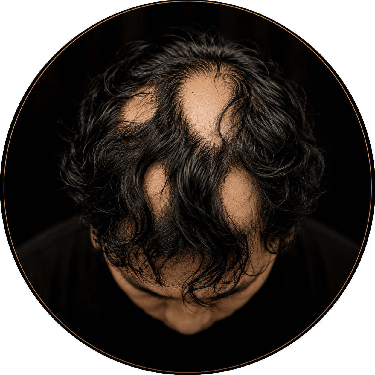 Alopecia areata patchy hair loss before scalp micropigmentation by Joe V. Nguyen, SMPCA San Lorenzo
