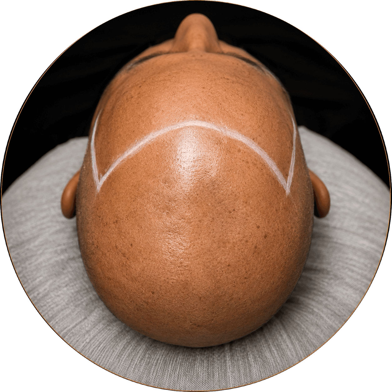 Male pattern baldness Norwood scalp micropigmentation hairline restoration, San Lorenzo CA