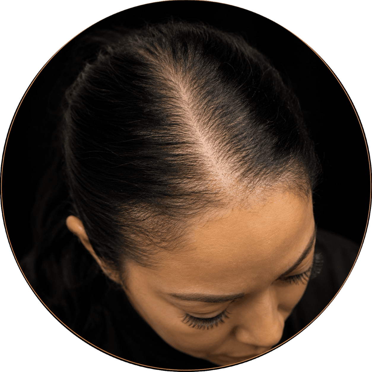 Postpartum and pregnancy hair loss scalp micropigmentation for women, SMPCA