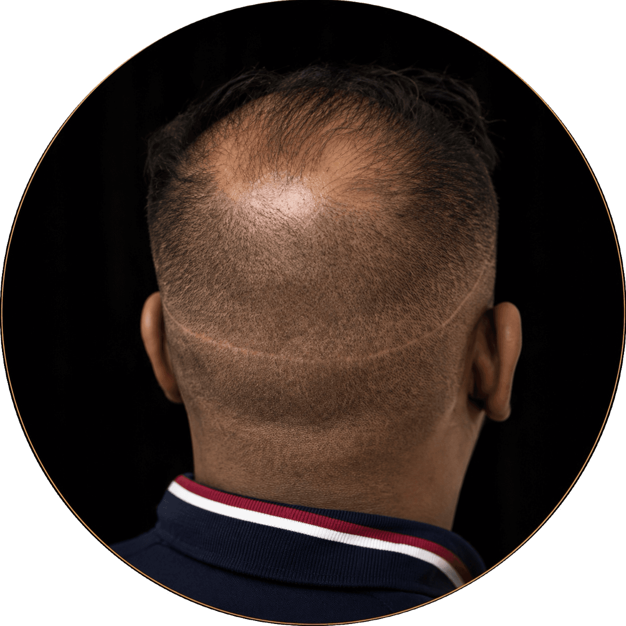 FUT FUE hair transplant scar camouflage with scalp micropigmentation, Bay Area