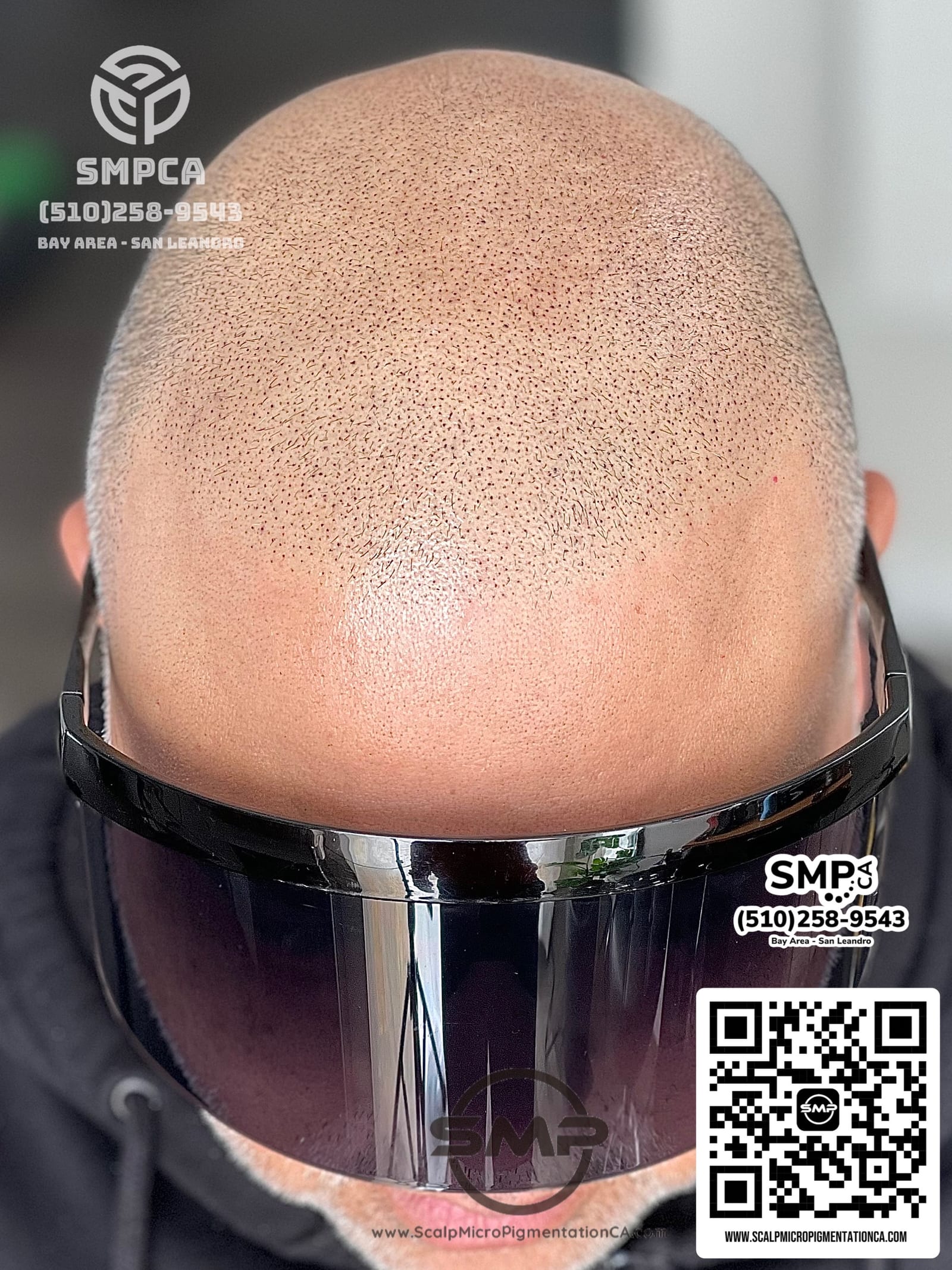 Norwood 7 full scalp coverage — after scalp micropigmentation by Joe V. Nguyen, SMPCA San Lorenzo