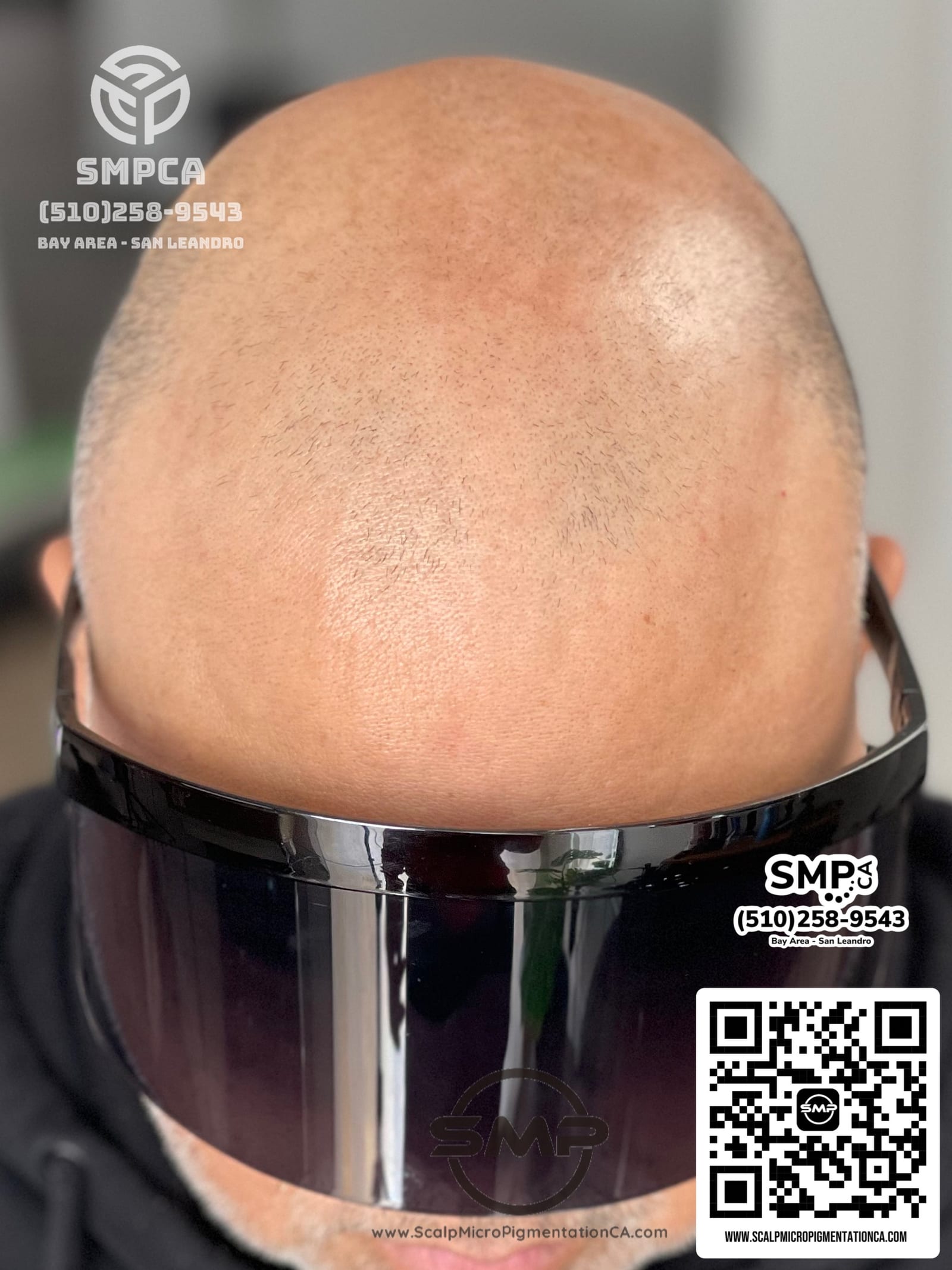 Norwood 7 male pattern baldness — before scalp micropigmentation by Joe V. Nguyen, SMPCA San Lorenzo