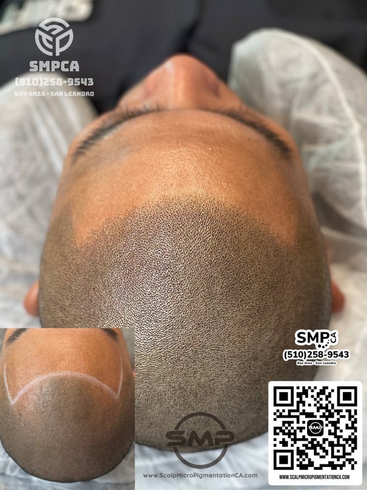 SMPCA scalp micropigmentation transformation 1 by Joe V. Nguyen, San Lorenzo CA