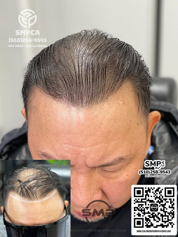 SMPCA scalp micropigmentation transformation 3 by Joe V. Nguyen, San Lorenzo CA