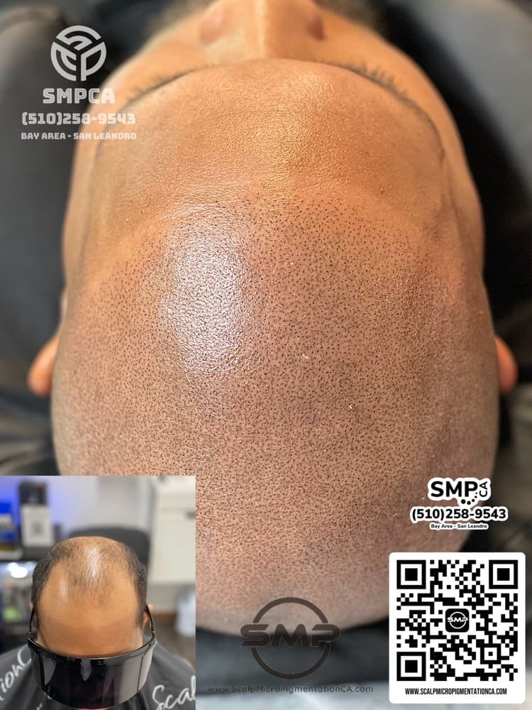 SMPCA scalp micropigmentation transformation 5 by Joe V. Nguyen, San Lorenzo CA