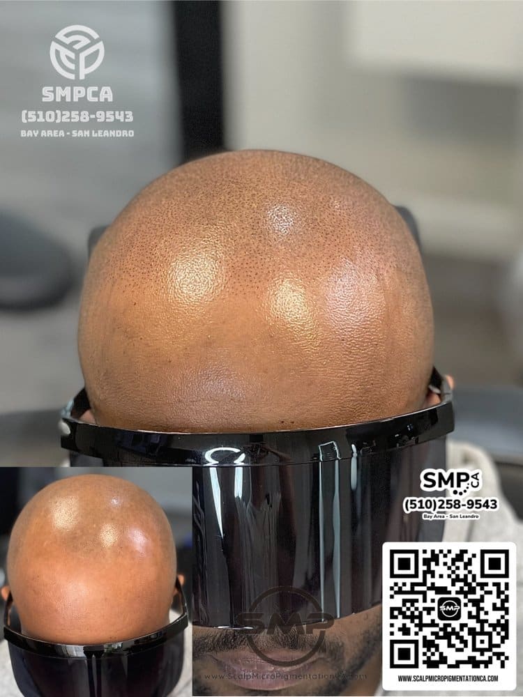 SMPCA scalp micropigmentation transformation 6 by Joe V. Nguyen, San Lorenzo CA
