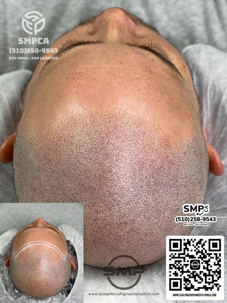 SMPCA scalp micropigmentation transformation 8 by Joe V. Nguyen, San Lorenzo CA