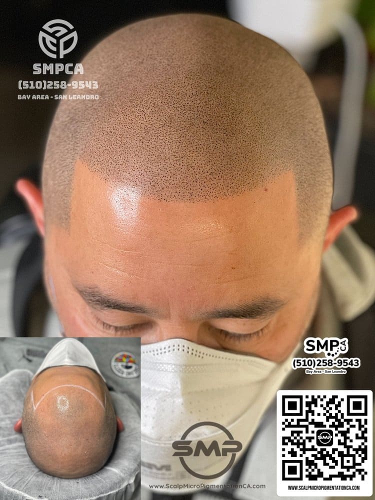 SMPCA scalp micropigmentation transformation 10 by Joe V. Nguyen, San Lorenzo CA
