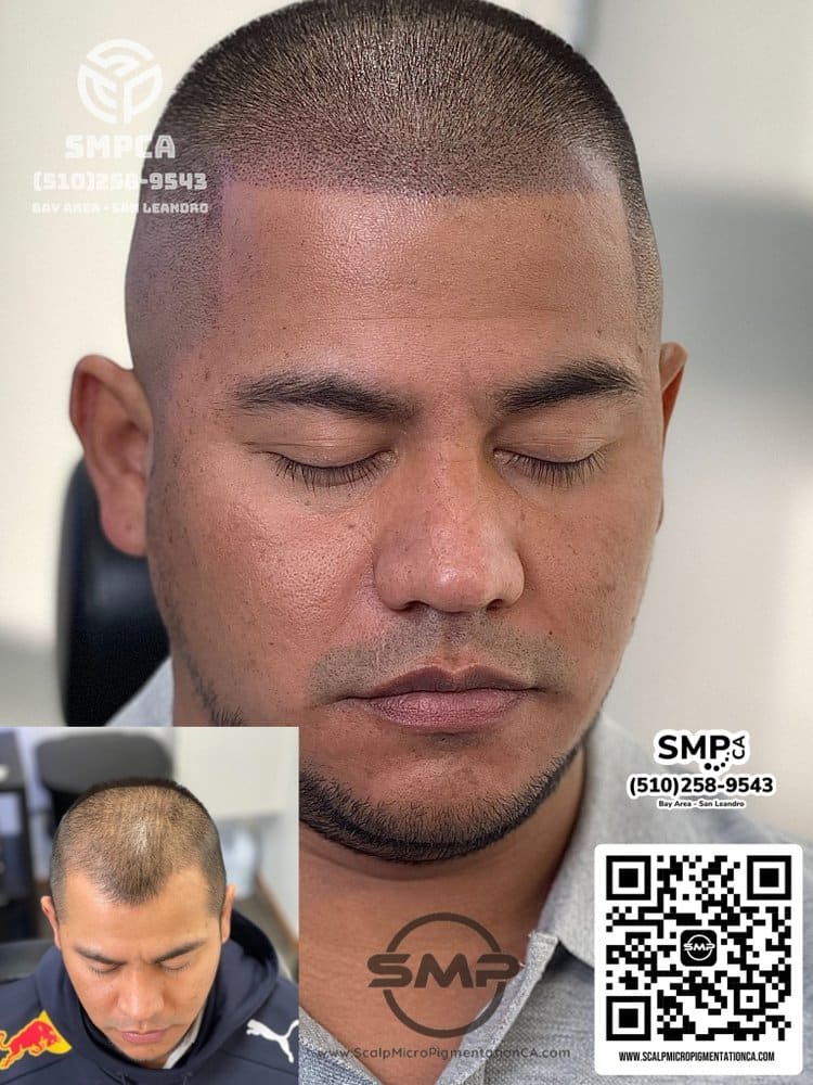 SMPCA scalp micropigmentation transformation 12 by Joe V. Nguyen, San Lorenzo CA