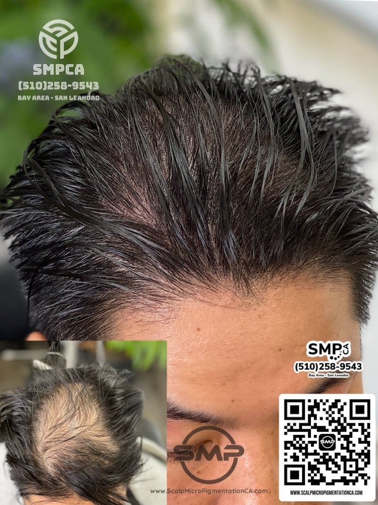 SMPCA scalp micropigmentation transformation 16 by Joe V. Nguyen, San Lorenzo CA