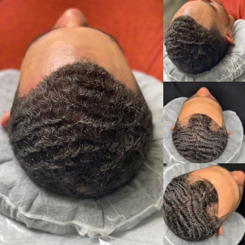 SMPCA scalp micropigmentation transformation 17 by Joe V. Nguyen, San Lorenzo CA