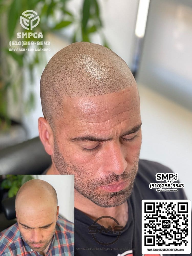 SMPCA scalp micropigmentation transformation 20 by Joe V. Nguyen, San Lorenzo CA