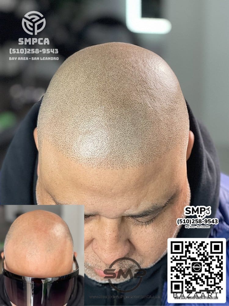 SMPCA scalp micropigmentation transformation 21 by Joe V. Nguyen, San Lorenzo CA