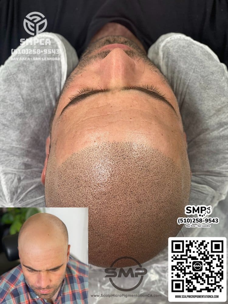SMPCA scalp micropigmentation transformation 22 by Joe V. Nguyen, San Lorenzo CA