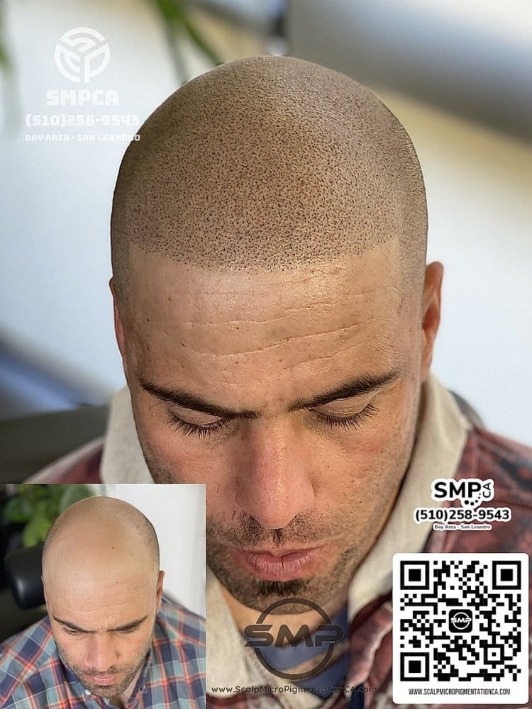 SMPCA scalp micropigmentation transformation 23 by Joe V. Nguyen, San Lorenzo CA