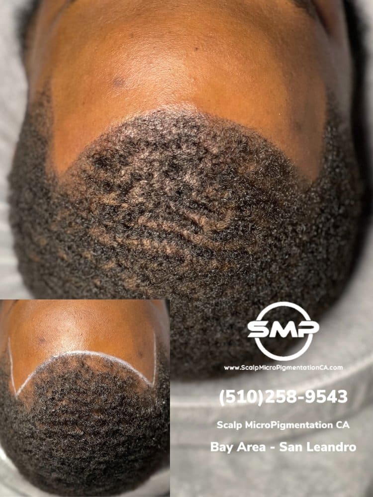 SMPCA scalp micropigmentation transformation 28 by Joe V. Nguyen, San Lorenzo CA