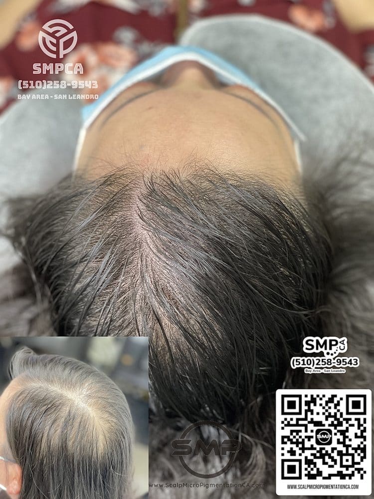 SMPCA scalp micropigmentation transformation 30 by Joe V. Nguyen, San Lorenzo CA