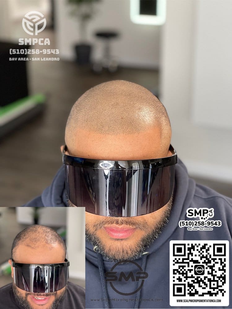 SMPCA scalp micropigmentation transformation 31 by Joe V. Nguyen, San Lorenzo CA