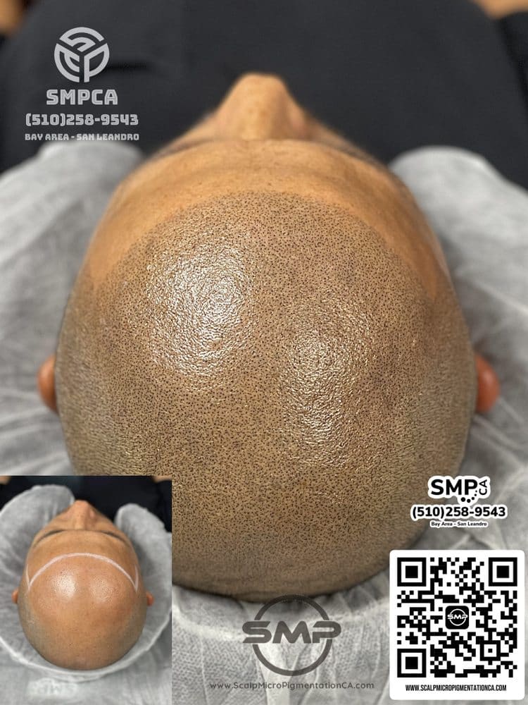 SMPCA scalp micropigmentation transformation 35 by Joe V. Nguyen, San Lorenzo CA