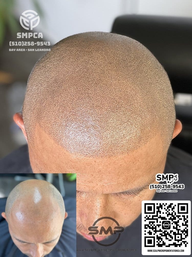 SMPCA scalp micropigmentation transformation 36 by Joe V. Nguyen, San Lorenzo CA