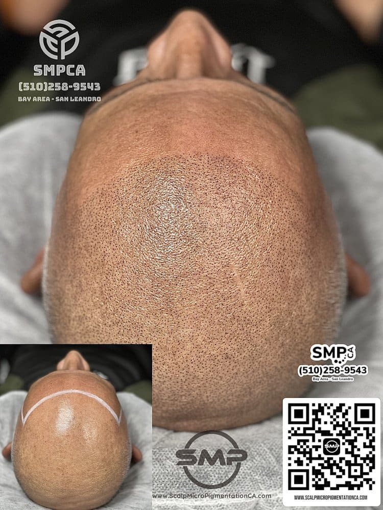 SMPCA scalp micropigmentation transformation 37 by Joe V. Nguyen, San Lorenzo CA