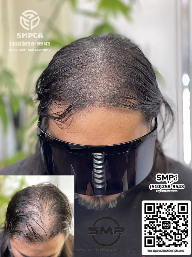 SMPCA scalp micropigmentation transformation 40 by Joe V. Nguyen, San Lorenzo CA