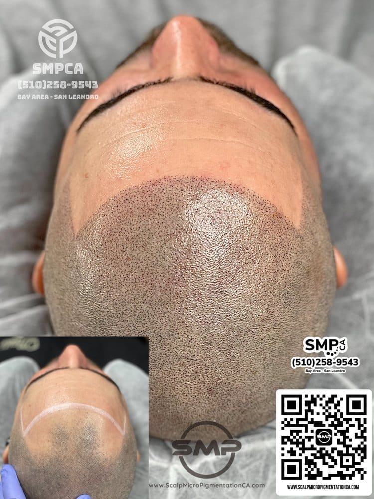 SMPCA scalp micropigmentation transformation 43 by Joe V. Nguyen, San Lorenzo CA
