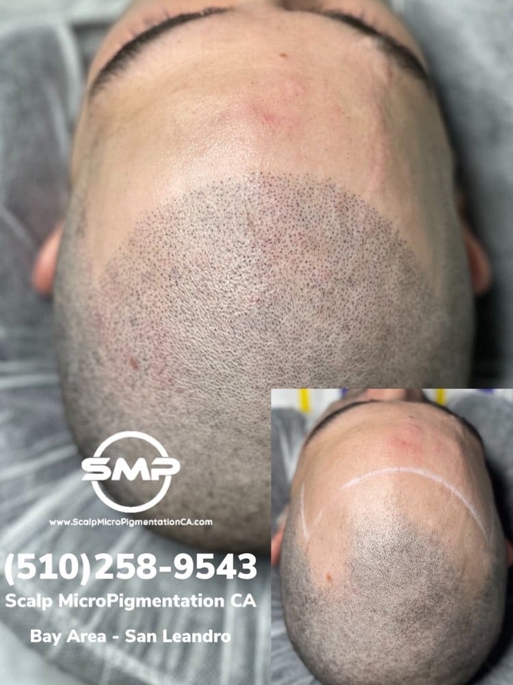 SMPCA scalp micropigmentation transformation 45 by Joe V. Nguyen, San Lorenzo CA