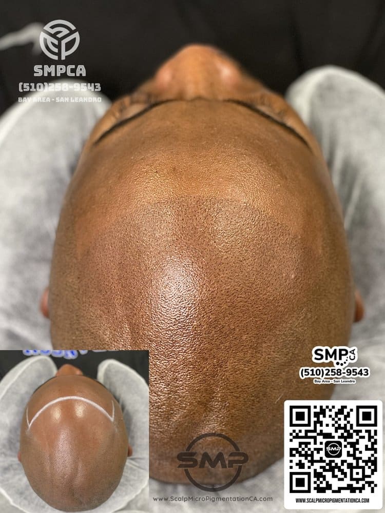 SMPCA scalp micropigmentation transformation 47 by Joe V. Nguyen, San Lorenzo CA