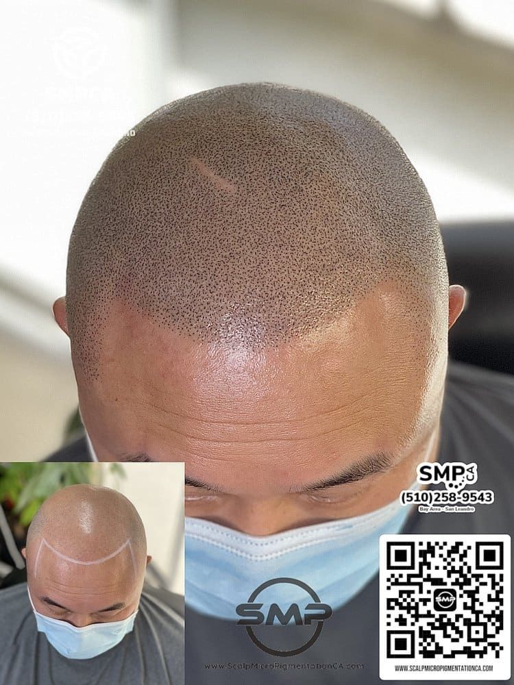 SMPCA scalp micropigmentation transformation 48 by Joe V. Nguyen, San Lorenzo CA