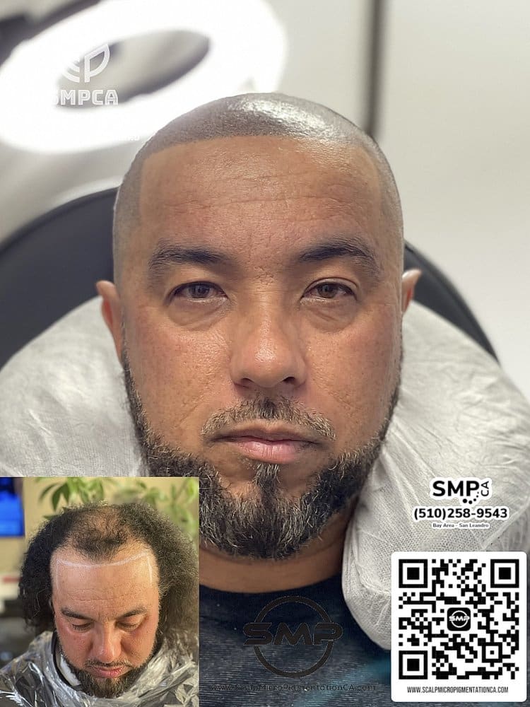 SMPCA scalp micropigmentation transformation 51 by Joe V. Nguyen, San Lorenzo CA