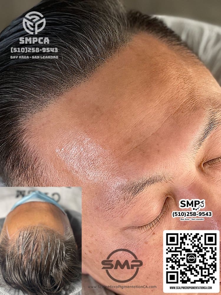 SMPCA scalp micropigmentation transformation 53 by Joe V. Nguyen, San Lorenzo CA