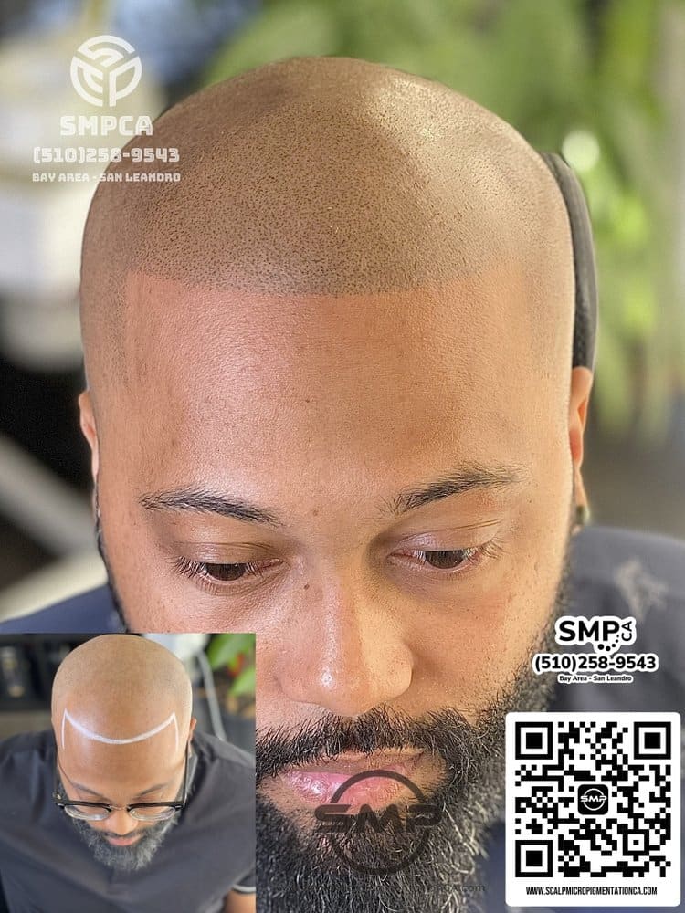 SMPCA scalp micropigmentation transformation 57 by Joe V. Nguyen, San Lorenzo CA