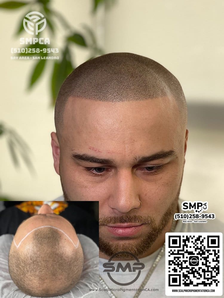 SMPCA scalp micropigmentation transformation 59 by Joe V. Nguyen, San Lorenzo CA