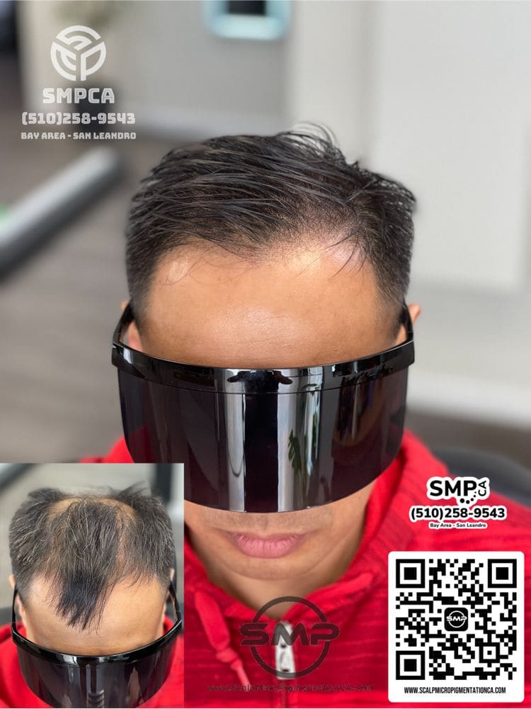 SMPCA scalp micropigmentation transformation 63 by Joe V. Nguyen, San Lorenzo CA