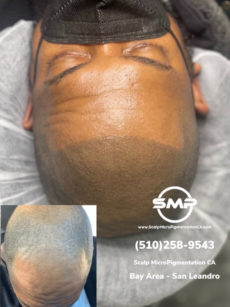 SMPCA scalp micropigmentation transformation 66 by Joe V. Nguyen, San Lorenzo CA