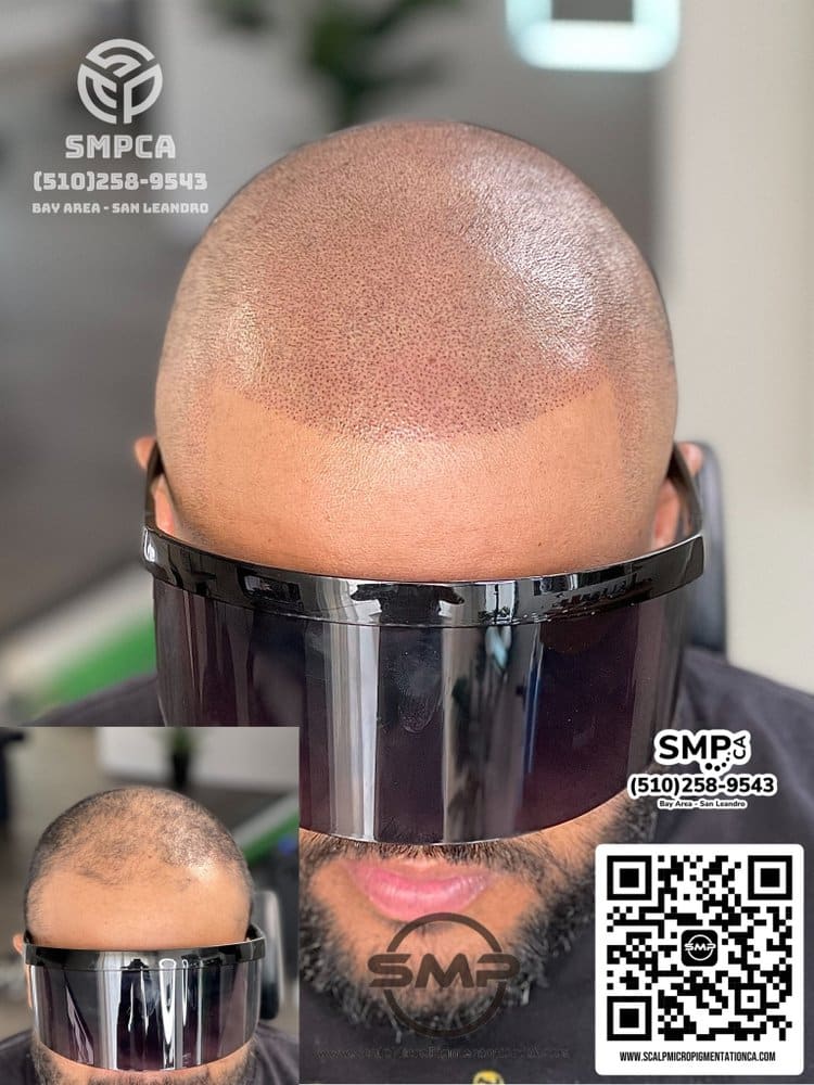 SMPCA scalp micropigmentation transformation 72 by Joe V. Nguyen, San Lorenzo CA