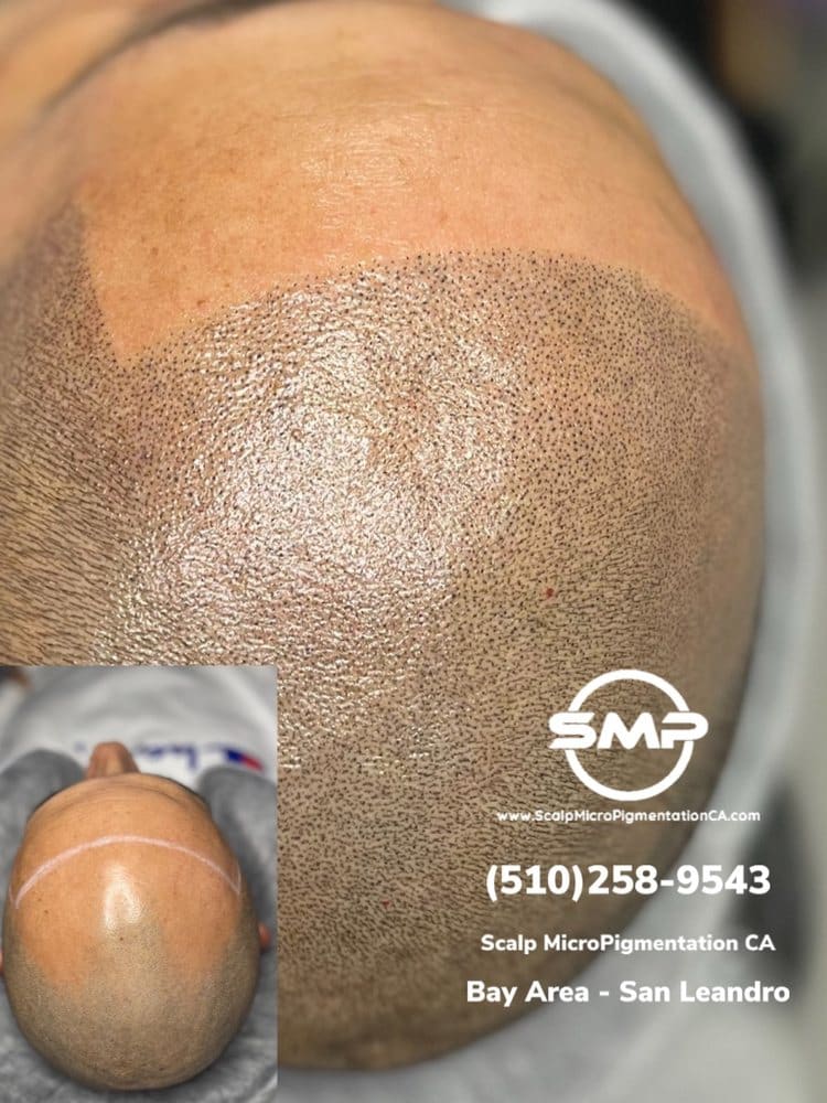 SMPCA scalp micropigmentation transformation 73 by Joe V. Nguyen, San Lorenzo CA